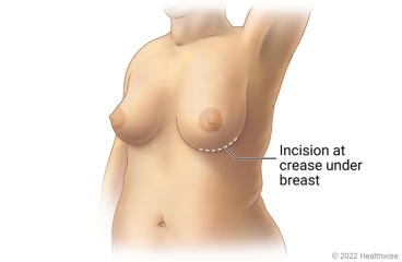 Nipple-sparing Mastectomy With Inframammary Cut - Health Library