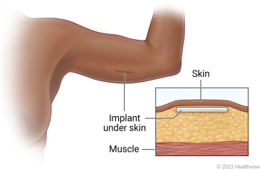 Site of implant in upper arm, with detail of implant under skin above muscle.