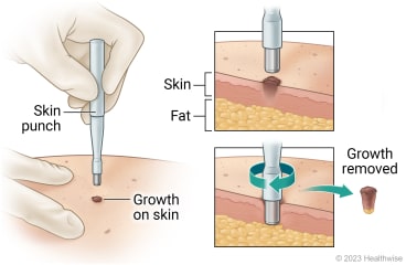 Skin punch placed over growth on skin, with detail of punch pushed down into layers of skin and rotated to remove growth.