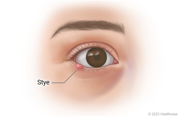 Eye with stye on lower eyelid.