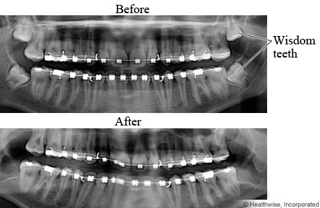 X-rays of mouth before and after wisdom teeth removal.