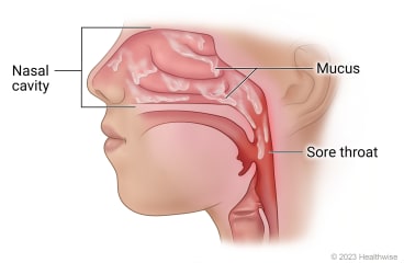 Inside view of mucus draining from nasal cavity into throat, causing sore throat.