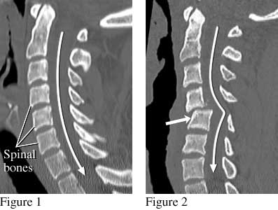 CT scan of the cervical spine (neck) showing a normal and a dislocated spine