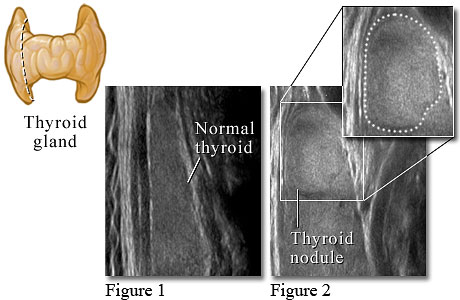 normal thyroid ultrasound