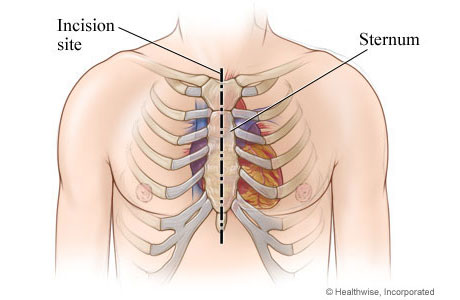 Chest incision site down the middle of the sternum from top to bottom of sternum.