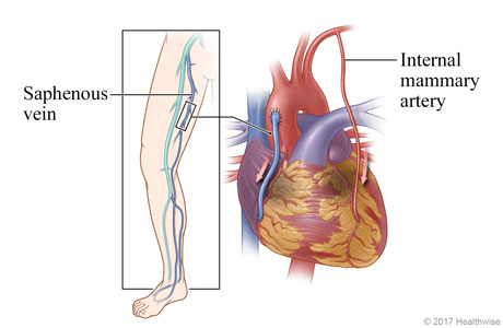 Location of saphenous vein in leg, and heart showing saphenous vein and an internal mammary artery used to bypass the diseased coronary artery