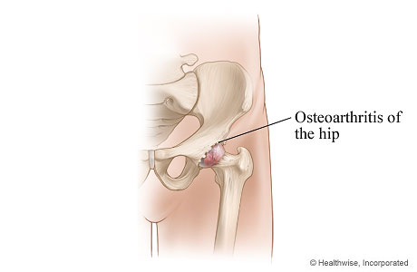 Osteoarthritis of the hip.