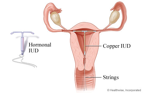Picture of an intrauterine device (IUD)