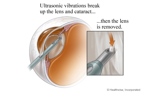 Cataract being broken up using ultrasound and removed using suction