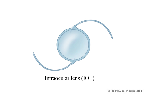 An intraocular lens (IOL)