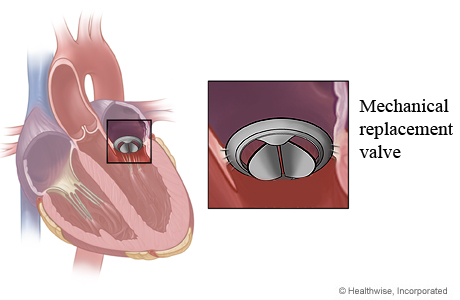 Mechanical mitral valve in heart and close-up of mechanical replacement valve