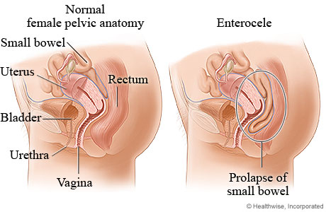 Small bowel prolapse.