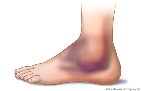 Picture of swelling and bruising of the ankle