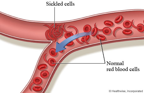 What do normal red blood cells look like?