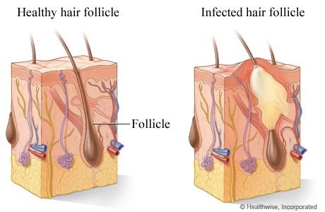 A healthy hair follicle and an infected hair follicle.