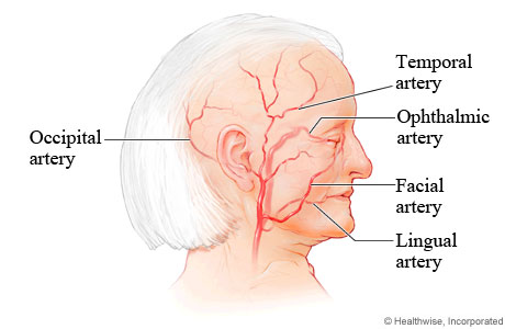 Arteries commonly affected by giant cell arteritis