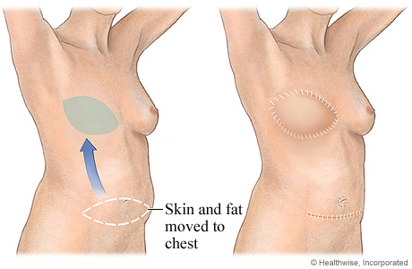 DIEP Flap For Breast Reconstruction - Health Library