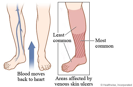 Veins in lower legs, showing areas affected by venous skin ulcers, including most common area from ankle to below the calf and less common areas of foot and calf.