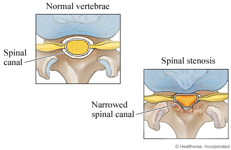 Lumbar Spinal Stenosis  Columbia Orthopaedic Group