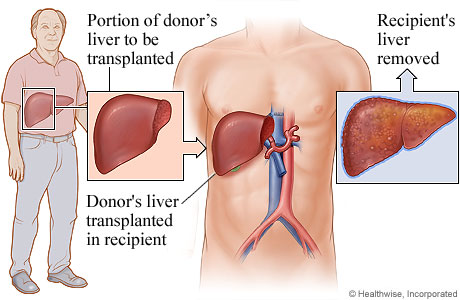 Living-donor liver transplant.