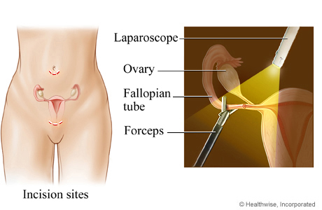 Picture of laparoscopic tubal ligation for female sterilization