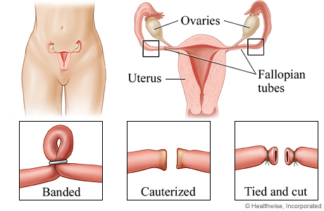 Picture of ligation methods for female sterilization