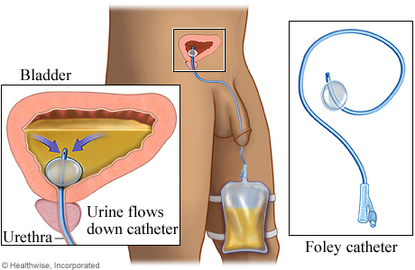 foley catheterization