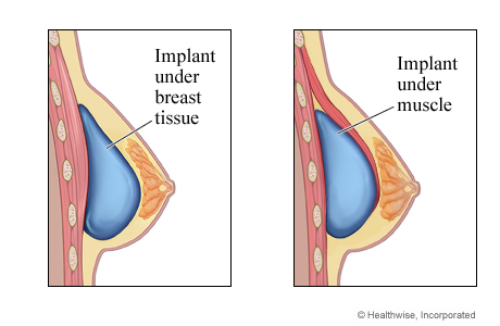 Breast implant under breast tissue and implant under muscle.