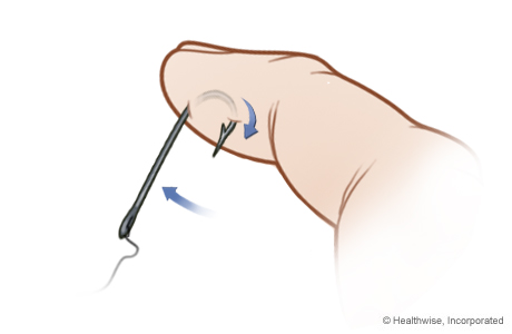 Advance-and-cut method of fishhook removal