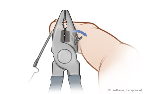 Advance-and-cut method of fishhook removal