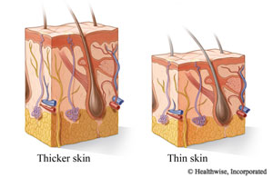 Drawings of a cross section of thicker skin and thinner skin