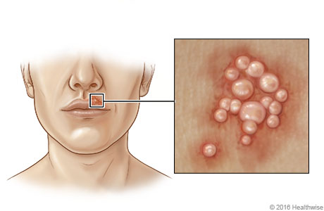Location of cold sores near mouth, with close-up of blisters