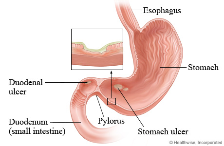 Peptic ulcers in the stomach and duodenum.