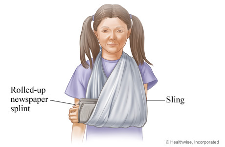 How to wear a splint or sling for an injured arm