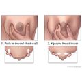 Breast Engorgement: Causes, Symptoms, Risks, Care and Prevention - By Dr.  Mohita