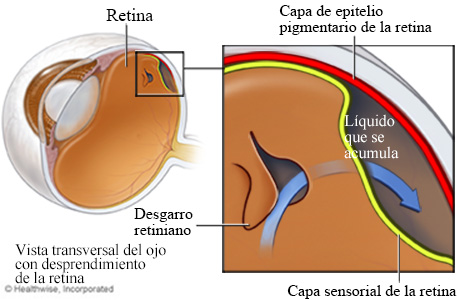 Desprendimiento de la retina