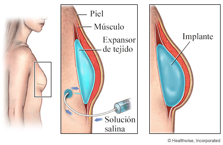 Expansor de tejido e implante mamario después de la mastectomía