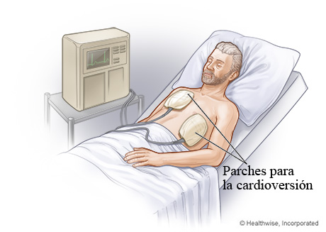 Cardioversión eléctrica con parches en el pecho.