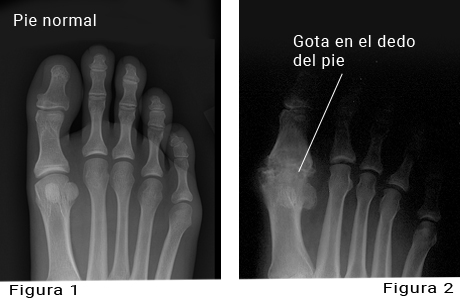 Imágenes radiográficas de un pie normal y un pie con gota en el dedo gordo del pie