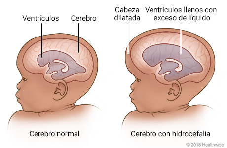 Vistas internas del cerebro normal de un bebé y de un cerebro con hidrocefalia que muestra la cabeza dilatada y los ventrículos llenos con exceso de líquido.