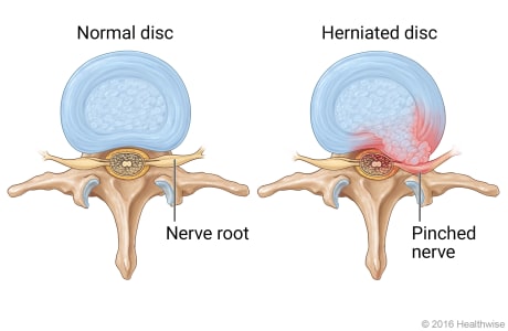 Vista superior de un disco normal con raíz nerviosa sana y vista superior de una hernia de disco con pinzamiento e inflamación de un nervio