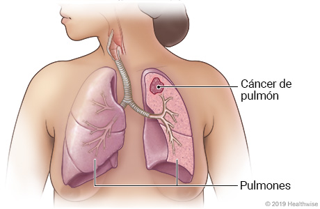Ubicación de los pulmones en el tórax, que muestra cáncer de pulmón en el lóbulo superior de un pulmón