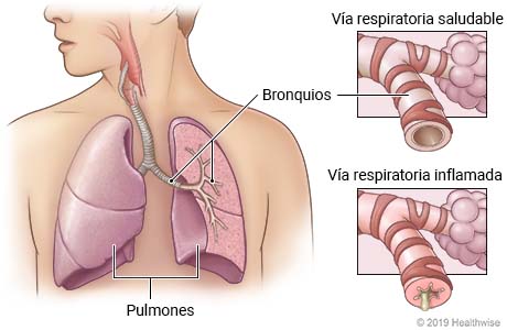 Pulmones en el pecho donde se muestran los bronquios en el pulmón izquierdo, con detalle de las vías respiratorias saludables y las vías respiratorias inflamadas por bronquitis