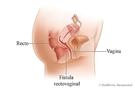 Imagen de una fístula rectovaginal