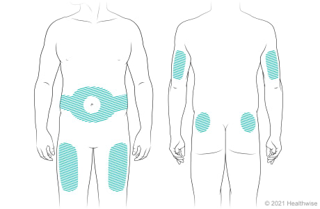 Vista anterior y posterior del cuerpo, donde se muestran zonas en las que se puede inyectar la insulina