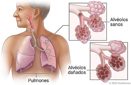Pulmones en el pecho, donde se muestra el interior de las vías respiratorias de un pulmón con detalle de alvéolos sanos y alvéolos dañados.
