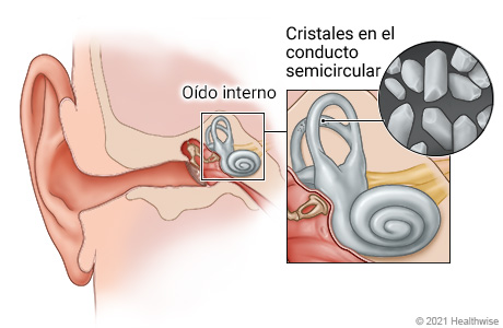 Anatomía del oído, que muestra detalles del oído interno y los conductos semicirculares, con un primer plano de los cristales en el conducto.