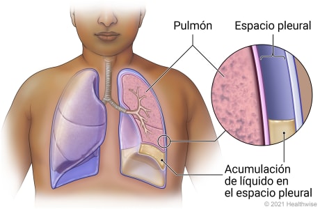 Pulmón con acumulación de líquido en el espacio pleural, con detalle del espacio pleural y la acumulación de líquido.