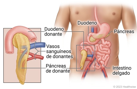 Órganos abdominales, incluidos el duodeno, el páncreas y el intestino delgado, y mostrando el trasplante de duodeno, páncreas y vasos sanguíneos de un donante en la parte inferior del abdomen y conectados al intestino delgado.