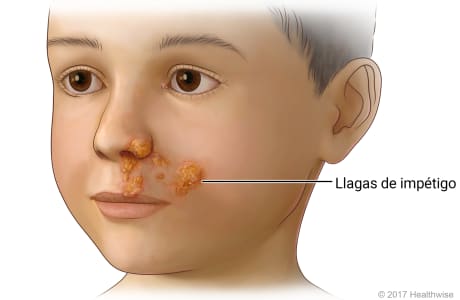 Placas de impétigo en el labio superior, la zona inferior de la nariz y la mejilla de un niño.